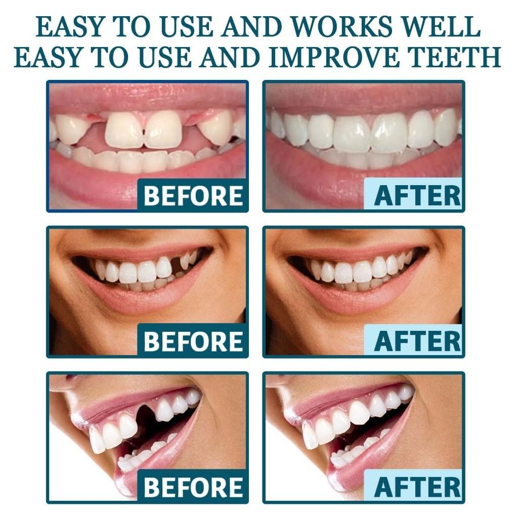 Eelhoe Gigi Palsu Snap-On Yang Dapat Disesuaikan Authentic Perawatan Kesehatan Gigi Palsu Renggang S