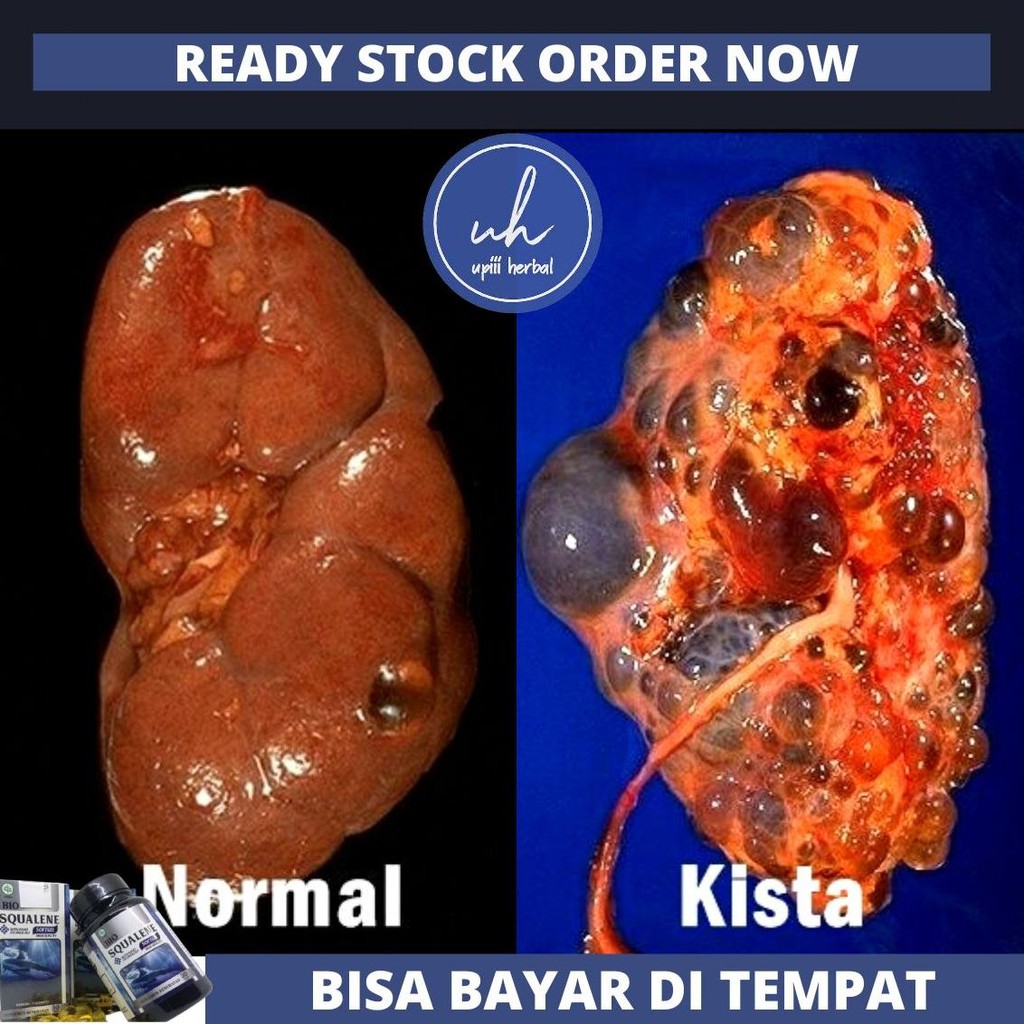 Obat Kista Ginjal, Obat Herbal Penghilang Kista Ginjal, Pencegahan Kista Ginjal, Obat Perawatan Ginj
