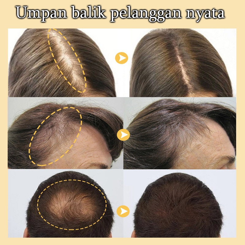 Romery Oil Untu Rambut Umbuh Rambut Erum Umbuh Rambut Hair Erum Rambut Ronto Hair Growth Vitan Umbuh