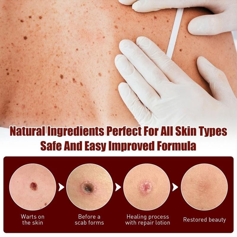Penghilang Kutil Dan Tahi Lalat Salep Kutil Paling Ampuh Skin Tag Remover Kutilos Untuk Wajah Dan Le