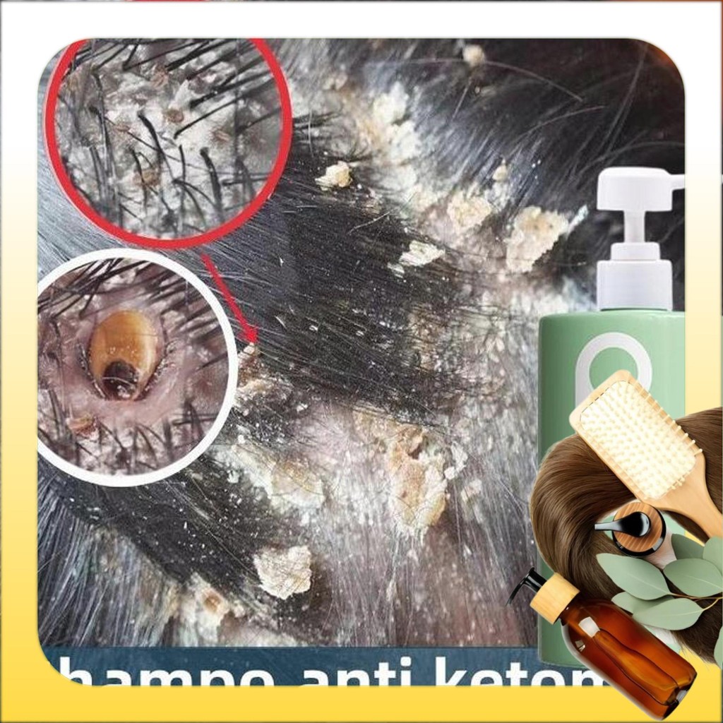 shampoo anti ketombe / sampo anti ketombe dan gatal / sampo anti ketombe ampuh ampuh / sampo anti ke