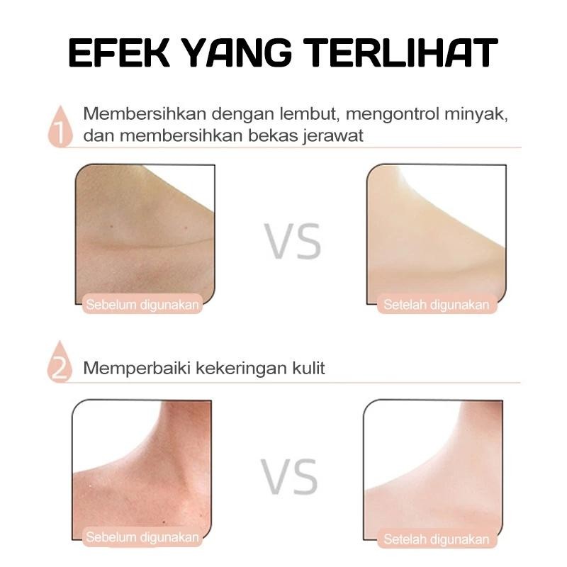 450Ml Eczema Body Wash Pengobatan Eksim Psoriasis Eksim Kering Kurap Gatal Kulit Jamur Kulit Eksim L
