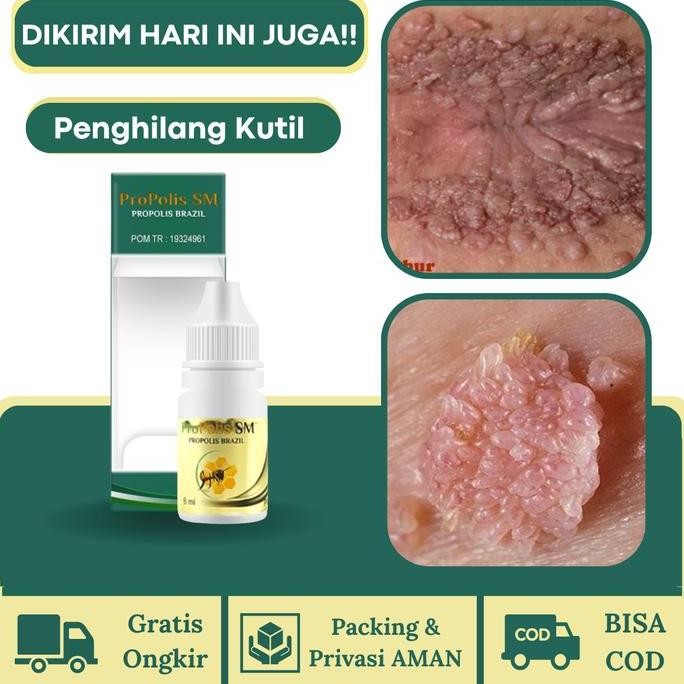 

READY PROPOLIS SM UNTUK KUTIL KELAMIN DUBUR KELAMIN JENGGER AYAM KONDILOMA AKUMINATA HPV