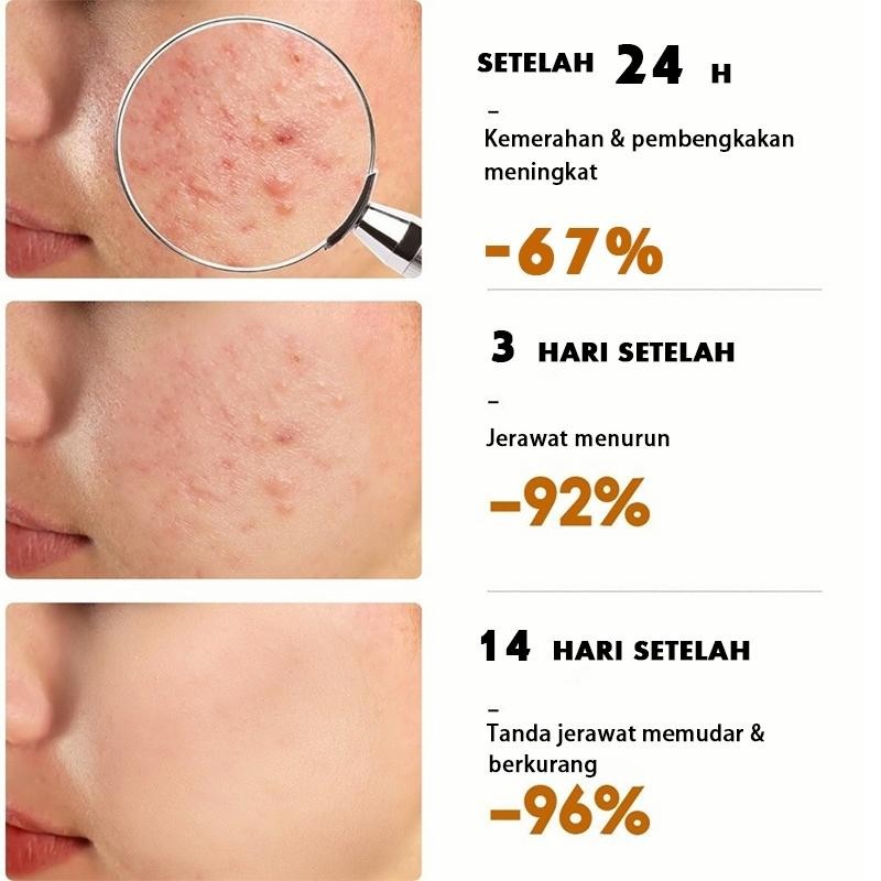 Ampuh Cream Penghilang Jerawat Permanen Bpom Penghilang Bekas Jerawat Bopeng Bekas Jerawat Pria Dan 