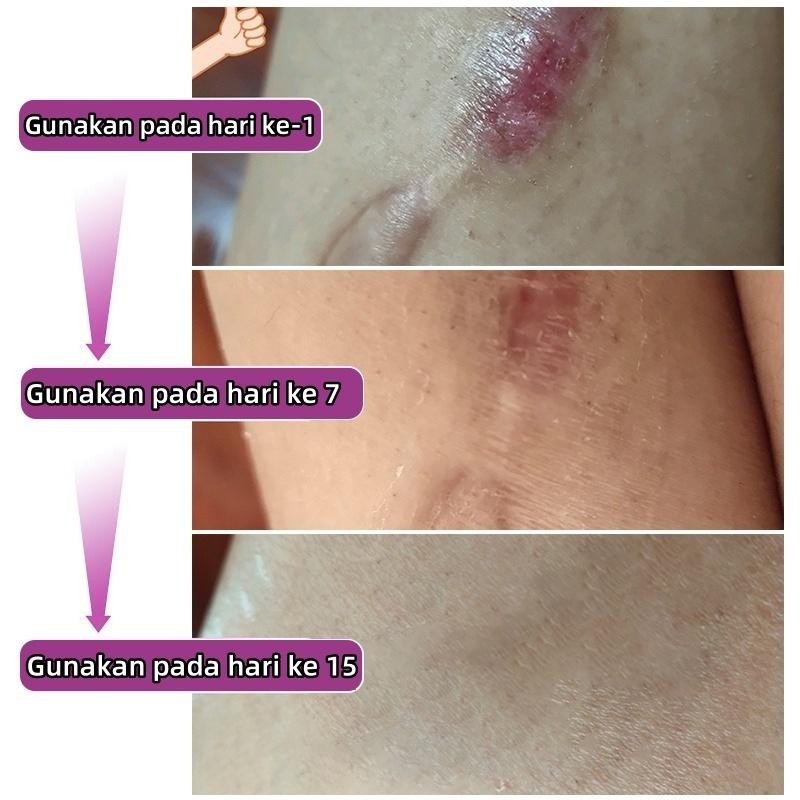 Sweetrip  Penghilang Bekas Luka Di Kaki Penghilang Bekas Luka Hitam Koreng Penghilang Bekas Cacar Ko