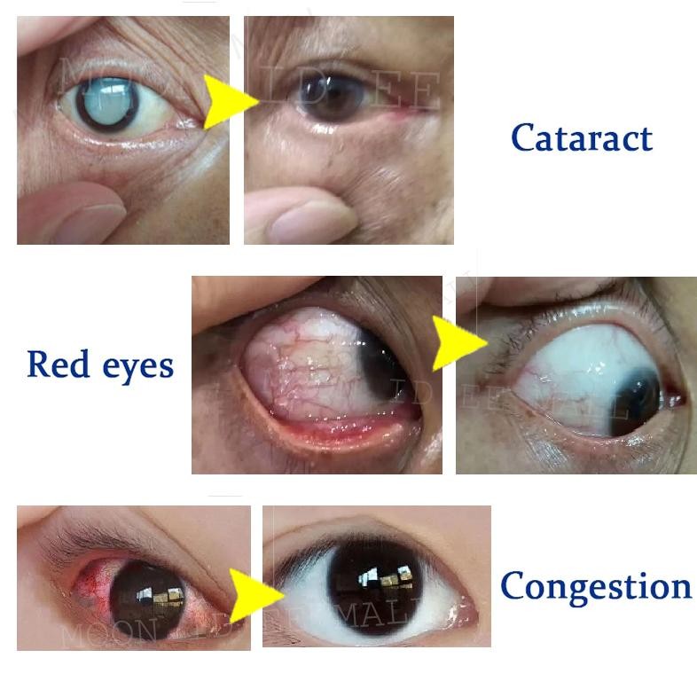 Ready Obat Mata Katarak Blueberry Eye Drop Obat Mata Merah Pengobatan Mata Rabun Mata Buram Mata Ker