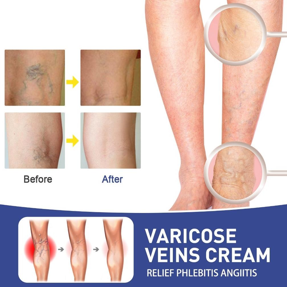 OUHOE Varicose Vein Patch 15pcs Obat Varises Koyo Varises Obat penghilang Varises Patch terlaris
