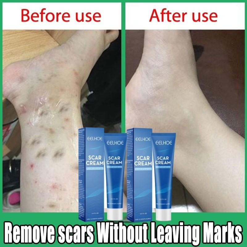 Salep Penghilang Bekas Luka Penghilang Bekas Luka Hitam Koreng Penghilang Bekas Luka Di Kaki Penghil