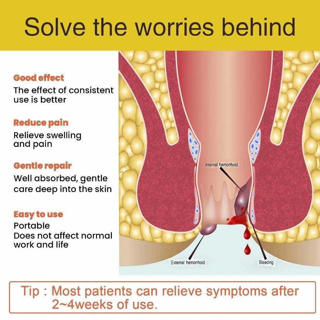 Thailand Obat Wasir Salep Wasir Salep Ambeien Paling Ampuh 20G Ekstrak Herbal Untuk Menghilangkan Am