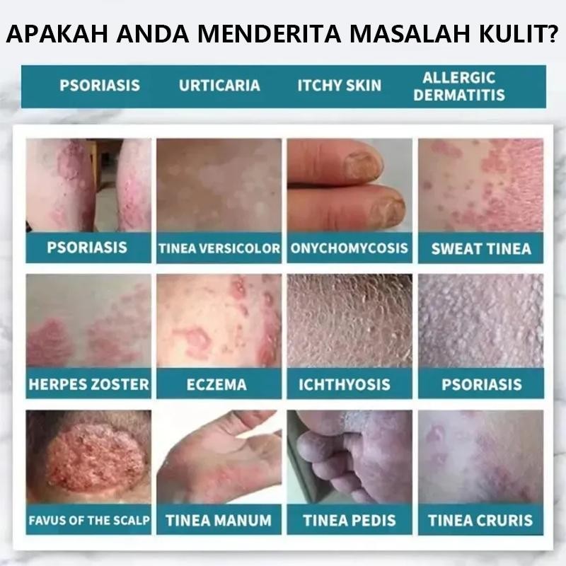 Salep Gatal Paling Ampuh Anti Jamur Gatal Gatal Seluruh Badan Obat Gatal Kulit Salep Eksim Gatal Sal