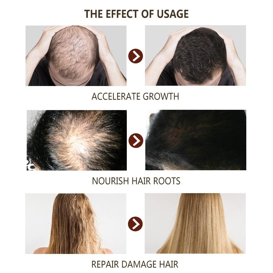 Rosemary Oil Rambut  Penumbuh Rambut Botak Perawatan Rambut Rontok Minyak Rosemary Untuk Rambut Obat