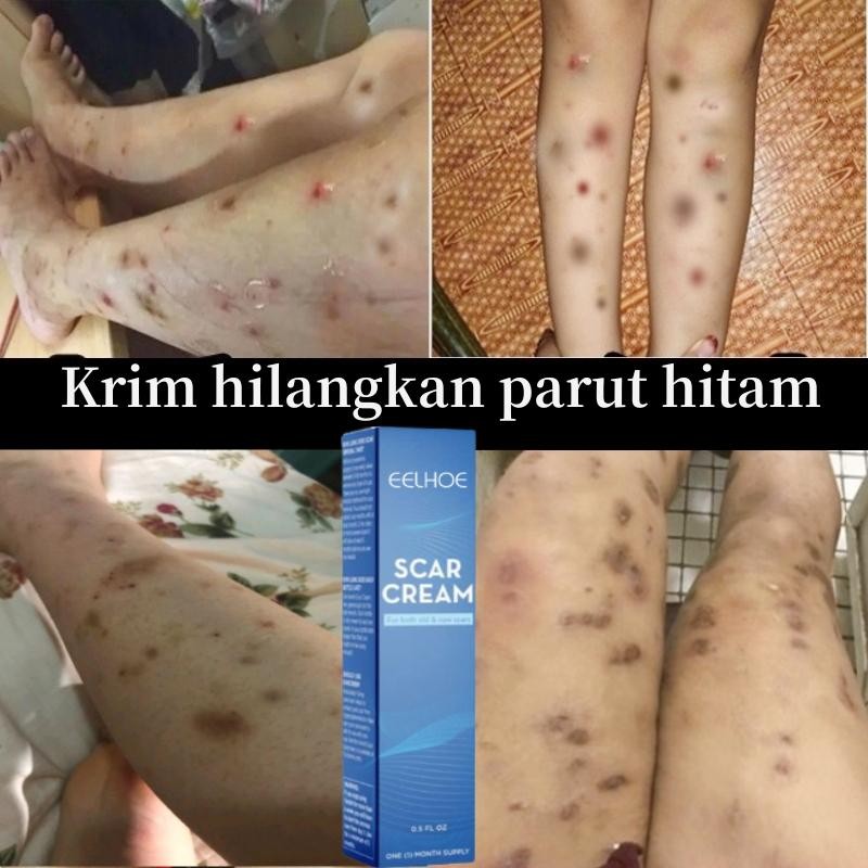 Salep Penghilang Bekas Luka Menghilangkan Bekas Luka Penghilang Bekas Luka Hitam Koreng Penghilang K