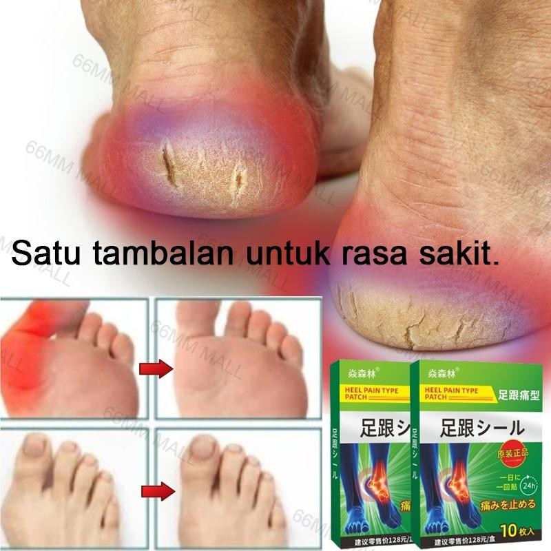 Nyeri Tumit Kaki Koyo Nyeri Tumit Kaki Pengobatan Nyeri Plantar Koyo Kaki Pereda Nyeri Koyo Telapak 