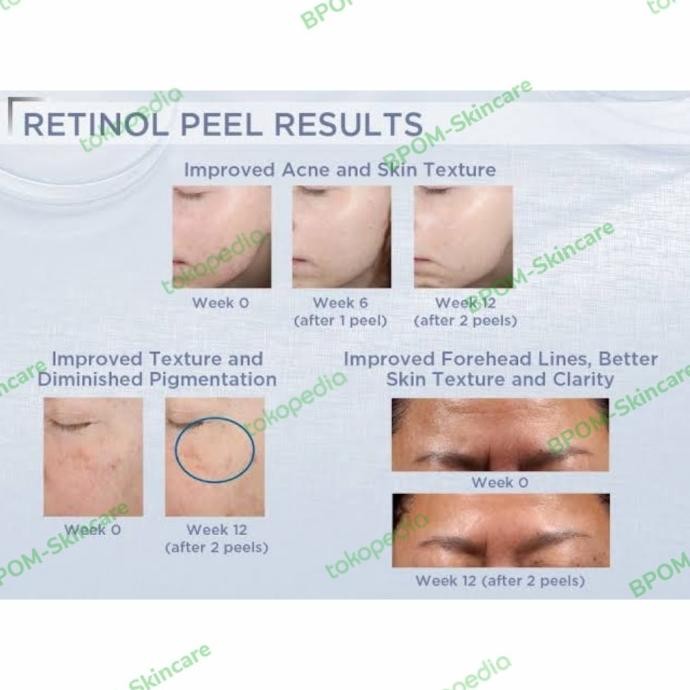 ala Neostrata Prosystem Retinol Peel 3% Brightening Antiaging Peeling USA