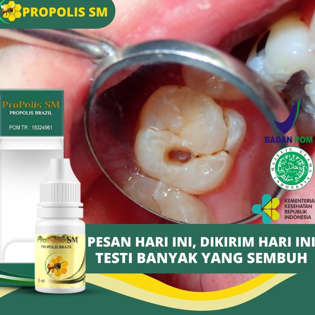 MARINA OBAT GIGI BERLUBANG, PENGHANCUR GIGI BERLUBANG, GIGI SERING NYUT NYUTAN, GUSI BENGKAK, GIGI N