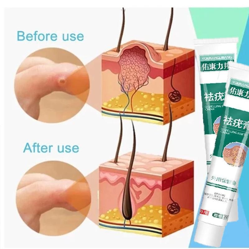 Obat Kutil Paling Ampuh Penghilang Kutil Dan Tahi Lalat Plester Kutil Mata Ikan Skin Tag Remover Pen