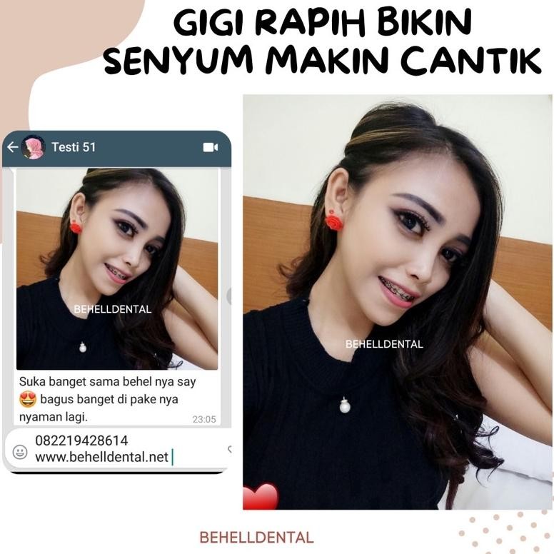 ORI BRACKET BEHEL GIGI MIM MINI ROTH 022 WITH HOOK 345 BIRU PREMIUM / Kawat Dental Comfort Usa Origi