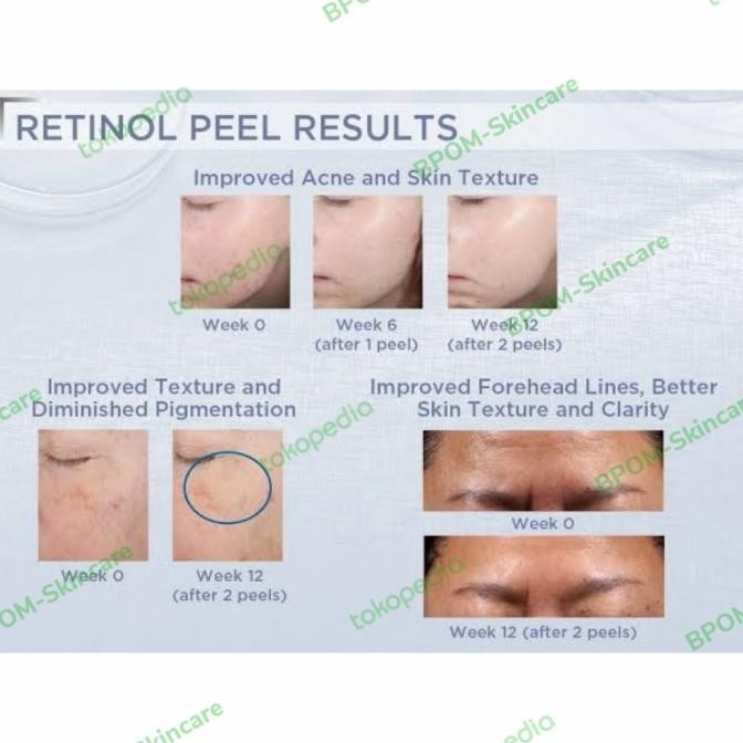 Neostrata Prosystem Retinol Peel 3% Brightening Antiaging Peeling USA LC