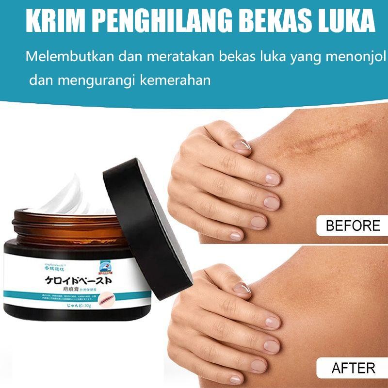 Scar Remover Cream Penghilang Bekas Luka Koreng Scar Remover Cream Obat Penghilang Bekas Luka Lama H