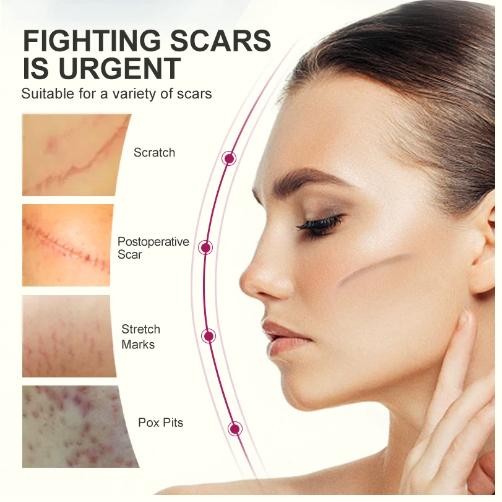 Obat Penghilang Bekas Luka Salep Penghilang Bekas Luka Ekstrak Tumbuhan Salep Luka Bakar Penghilang 