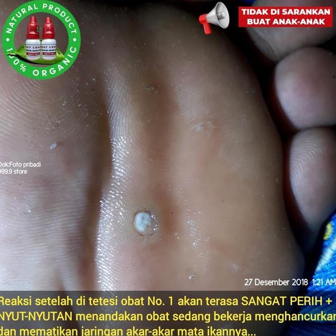 Obat Penyakit Mata Ikan Atau Clavus Bukan Plester Salep Callusol