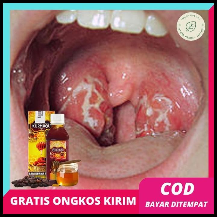 

Madu Khusus Amandel Herbal Untuk Anak Dan Dewasa - Penghancur Amandel - Pengempes Amandel - Radang Tenggorokan - Suara Serak Original Best Seller