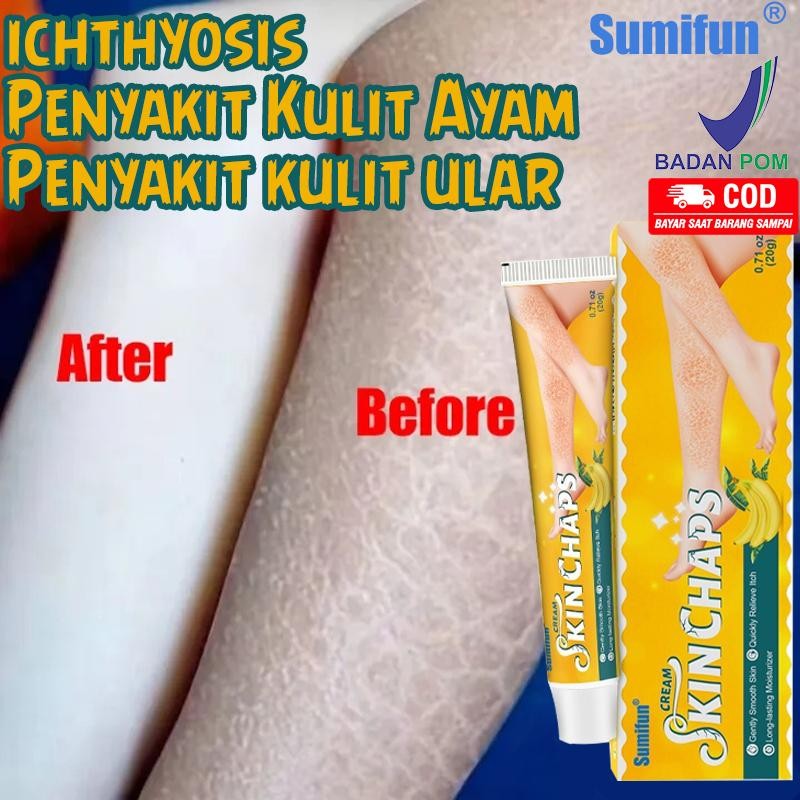 Obat Gatal Kulit Salep Eksim Iktiosis Iktiosis Kulit Obat Jamur Kulit Salep Kulit 20G Krim Kaki Peca