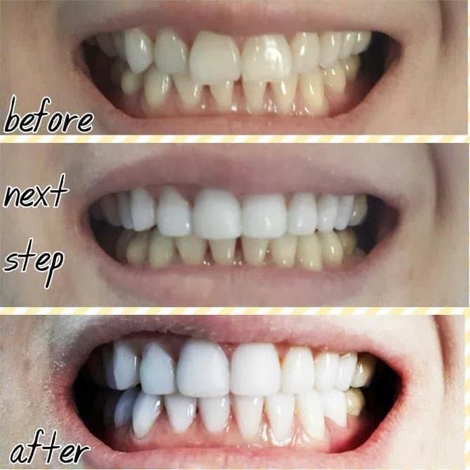 Veneer Gigi atas / bawah ( 8 gigi )