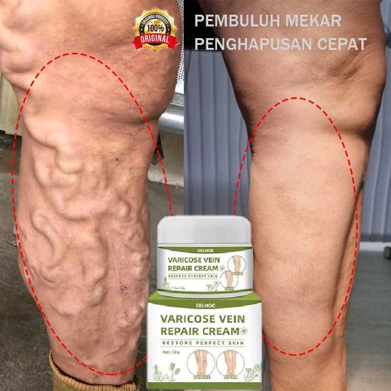 Obat Varises Cream Varises Paling Ampuh Original Varises Kaki Treatment Varicose Veins Cream Angiiti