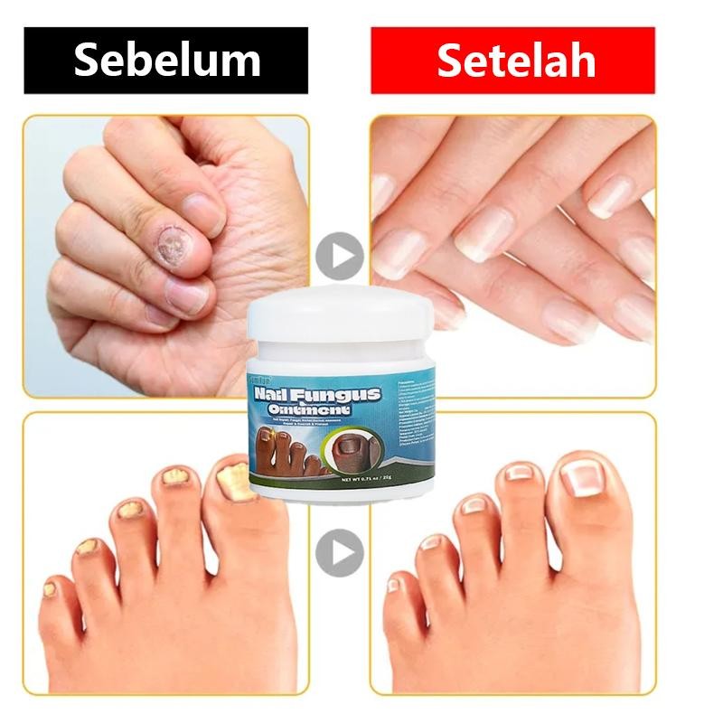 Obat Jamur Kuku Cream Jamur Kuku Obat Cantengan Salep Kuku Jamur Dan Rusak Obat Kuku Kaki Krim Kuku 