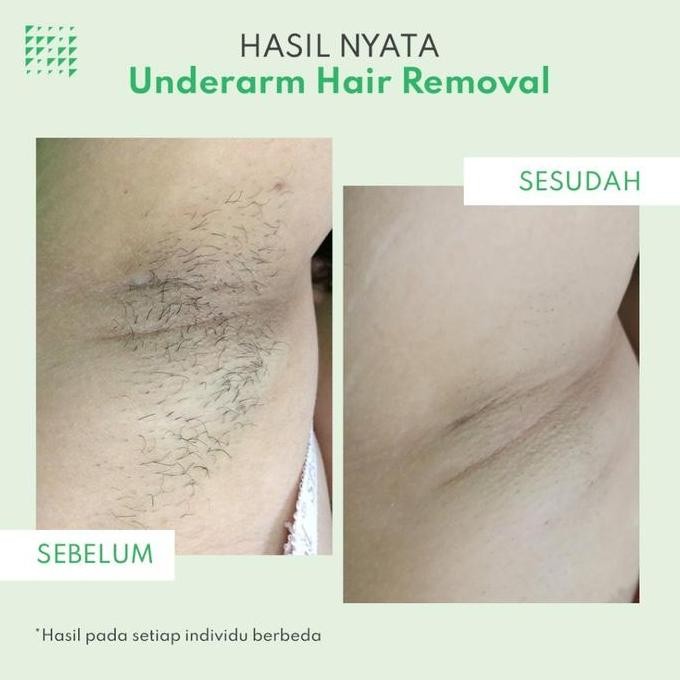 Promo Underarms Hair Removal - Zap