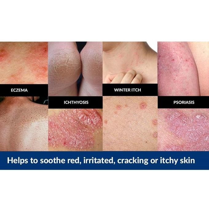 Vanicream Moisturizing Skin Cream For Sensitive Eczema Psoriasis Itchy