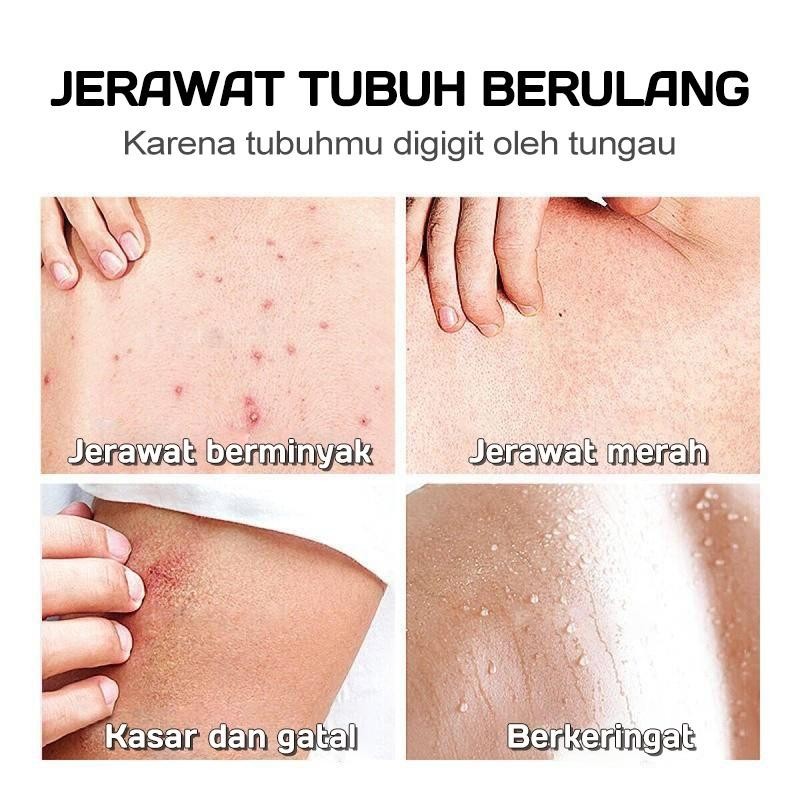Eczema Body Wash Obat Gatal Gatal Kulit Pengobatan Eksim Psoriasis Eksim Kering Kurap Gatal Kulit Ja