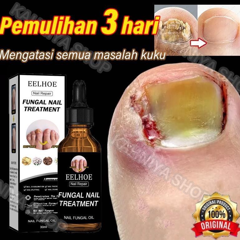 TERLARIS serum kuku obat kuku jamur dan rusak obat kuku jamur dan rusak obat jamur kuku vitamin kuku