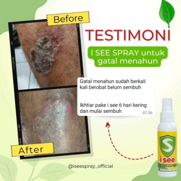 

ORIGINAL I See Synbiotik Water Spray - Obat Gatal Gatal Exim Luka Diabetes PREMIUM