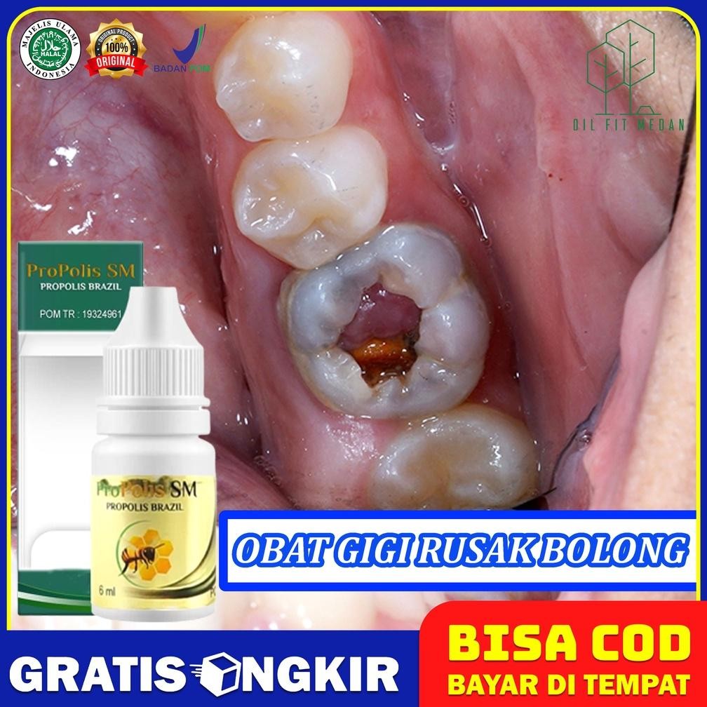 MARINA OBAT UNTUK GIGI RUSAK BOLONG TINGGAL TUNGGUL BISA LANGSUNG COPOT - GIGI BOLONG ATAS BAWAH - G