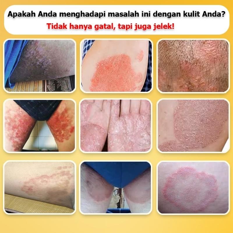 Obat Gatal Salep Gatal Selangkangan Salep Gatal China Paling Ampuh Salep Eksim Kering Paling Ampuh 5