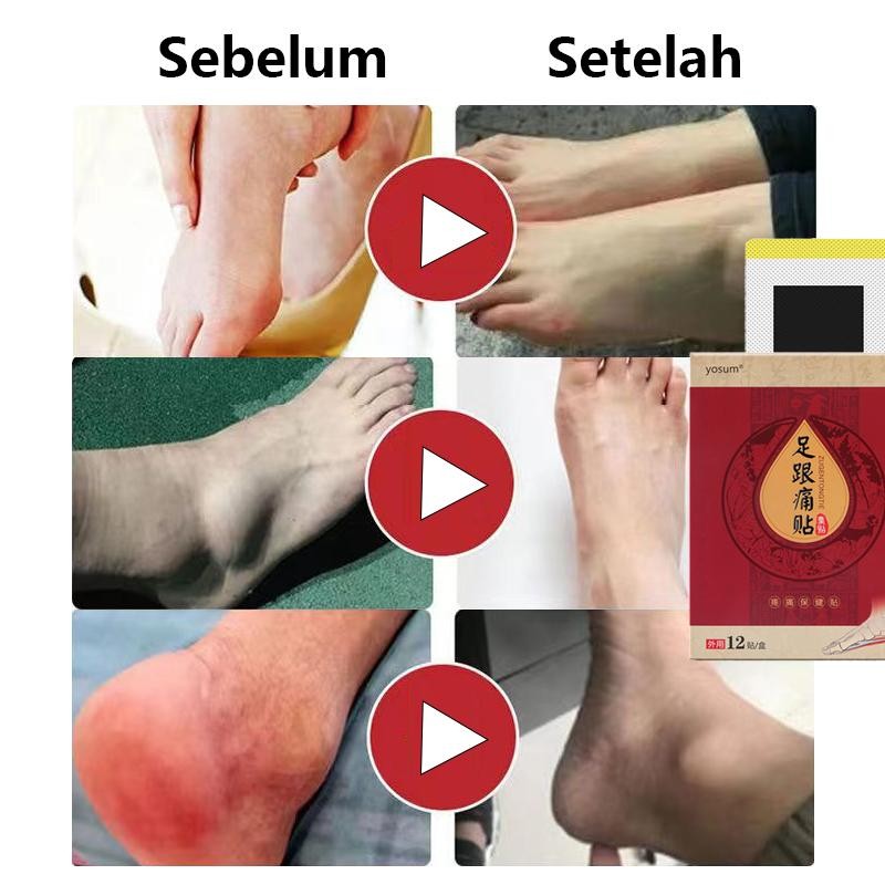 Sakit Tumit Koyo Kaki Pereda Nyeri Plantar Fasciitis Terapi Obat Sakit Kaki Obat Sakit Telapak Kaki 