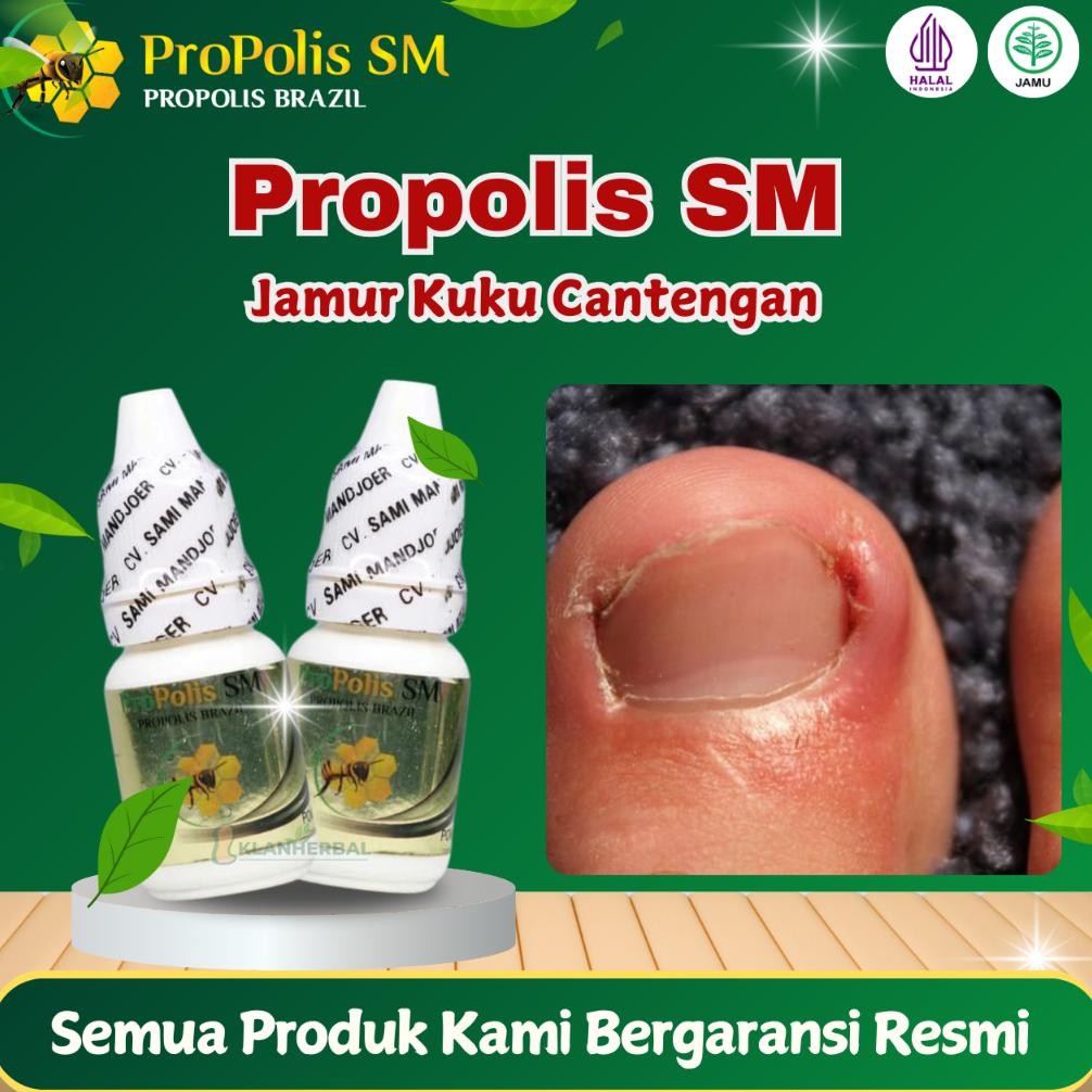PROPOLIS SM - OBAT KUKU JAMUR RUSAK, KUKU BAU BUSUK, KAKI JAMUR RUSAK CANTENGAN JEMPOL KAKI, PSORIAS