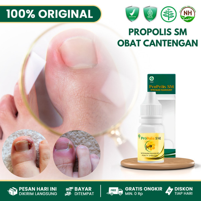 Propolis SM-Obat Cantengan Jempol Kaki Bengkak-Jamur Kuku Kaki-Bengkak