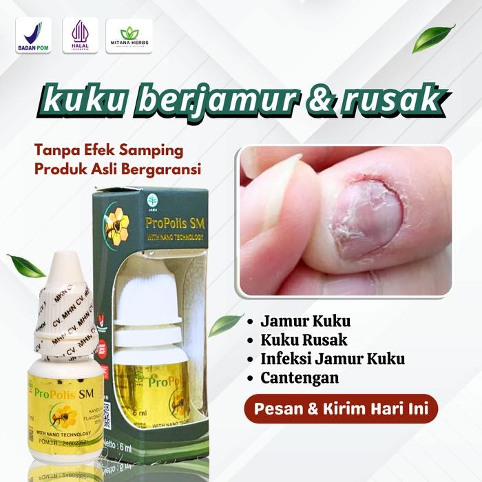 Kuku Berjamur dan Rusak Jamur Kuku Infeksi Jamur Kuku Cantengan Propolis SM Nail