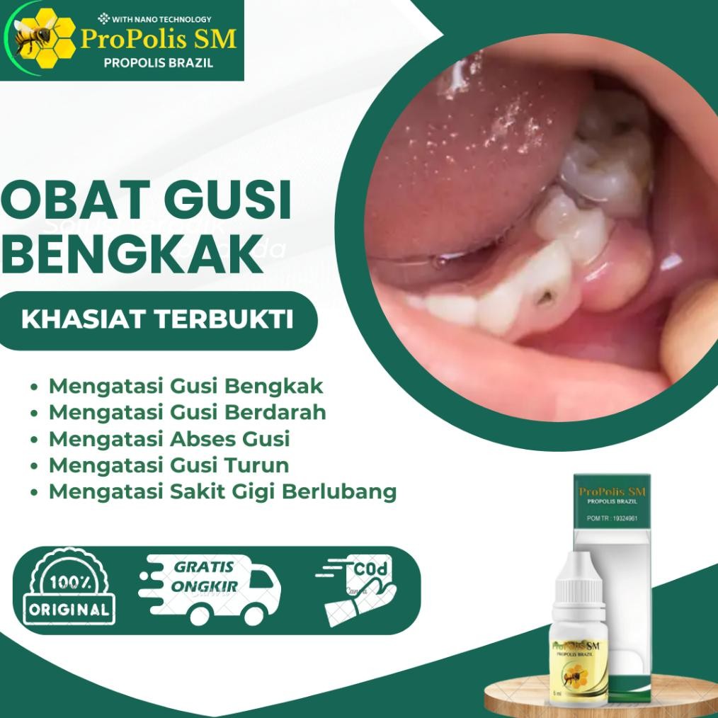 CHRIS OBAT GUSI BENGKAK, GUSI BERDARAH, GUSI TURUN, ABSES GUSI, GUSI BENGKAK DAN SAKIT GIGI, RESESI 