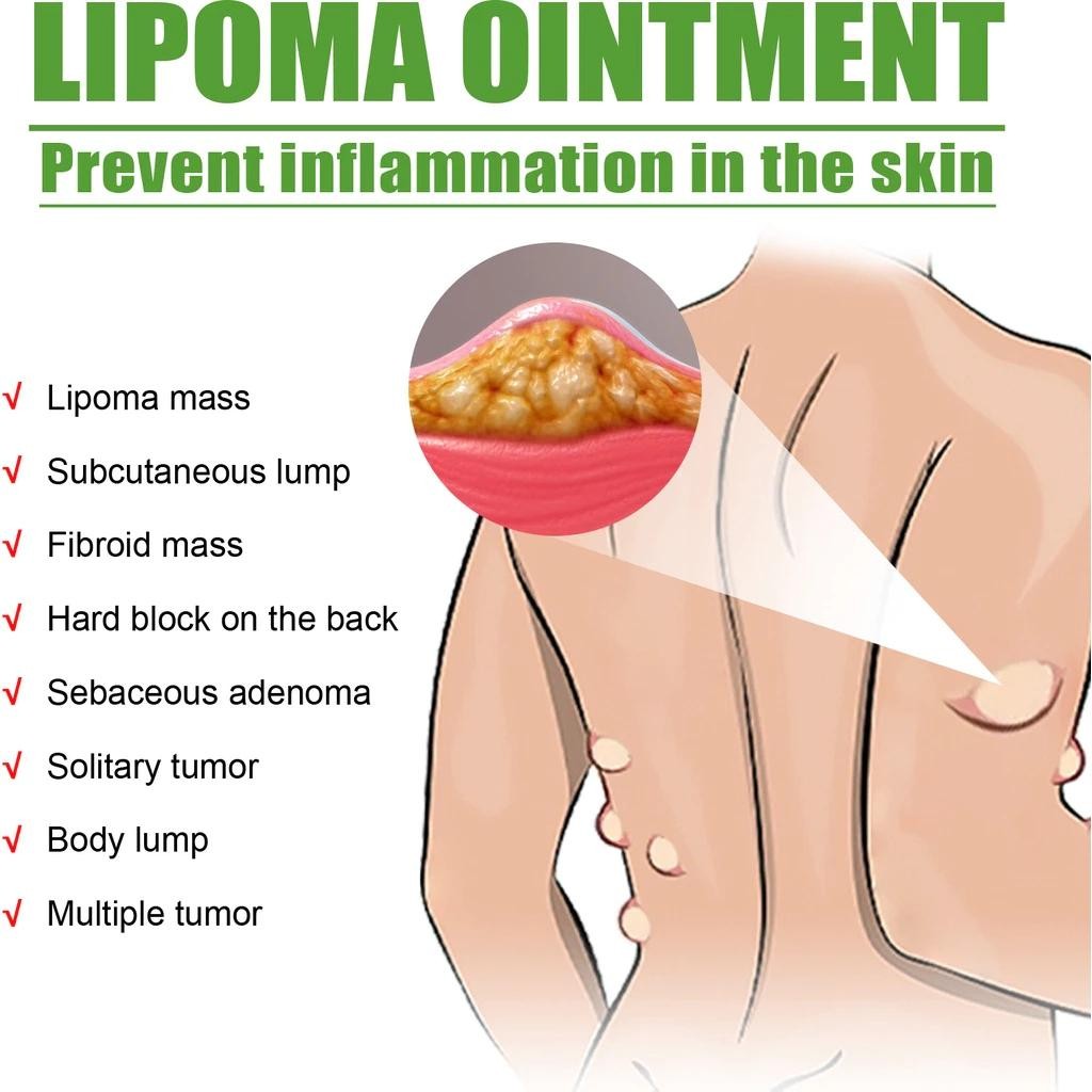 Sumifun 100% Efektif Lipoma Removal Cream Cellulite Salep Untuk Kulit Yang Sempurna Mencapai Kulit Y