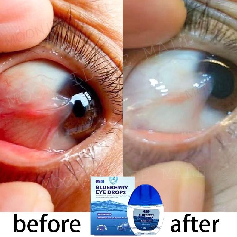 Obat Mata Katarak Blueberry Eye Drop Obat Mata Merah Pengobatan Mata Rabun Mata Buram Mata Kering Sa