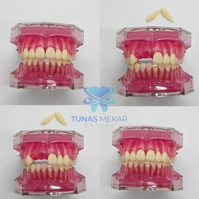 KALLIO DENTAL MODEL STUDY STUDI GIGI LEPASAN PHANTOM PANTUM GIGI LEPAS RUBBER