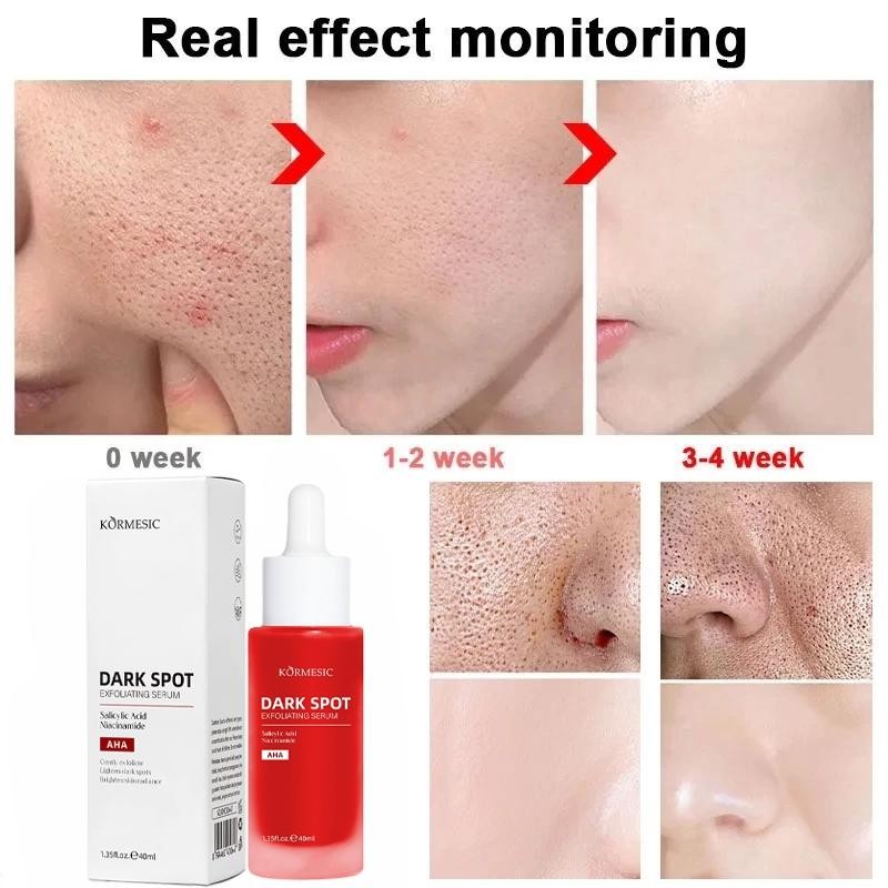 Serum Exfoliasi Wajah 40Ml Intensive Peeling Solution Serum  Exfoliasi Wajah Merah Exfoliating Serum