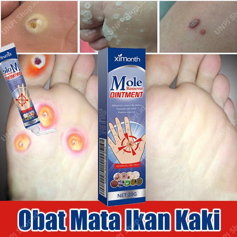 Salep Mata Ikan Ampuh Obat Mata Ikan Kaki Penghilang Mata Ikan Obat Penghilang Kutil Dan Tahi Lalat 