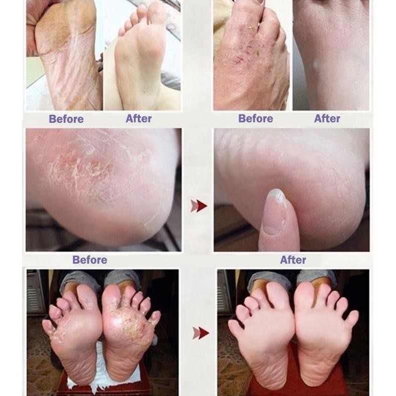 PJ Obat Kaki Rayapan Dan Bau Salep Obat Gatal Krim Pengelupas Kulit Mati Kaki Pembersih Kulit Mati T