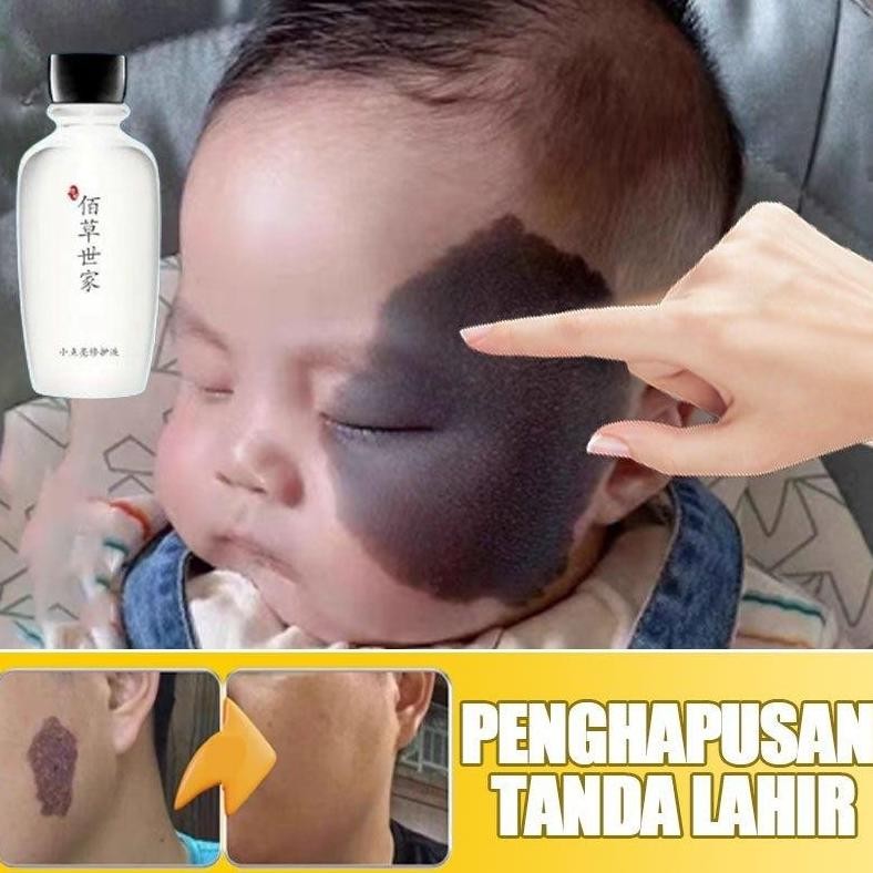 Penghilang Tanda Lahir Di Wajah Obat Penghilang Tanda Lahir Coklat Memudarkan Tanda Lahir Salep Peng