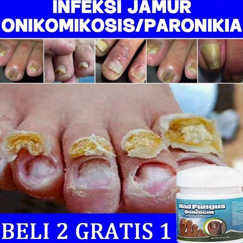 Obat Kuku Jamur Dan Rusak Obat Jamur Kuku Salep Kuku Jamur Dan Rusak Salep Jamur Kuku Obat Cantengan